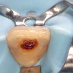 Le perforazioni iatrogene – Diagnosi e terapia