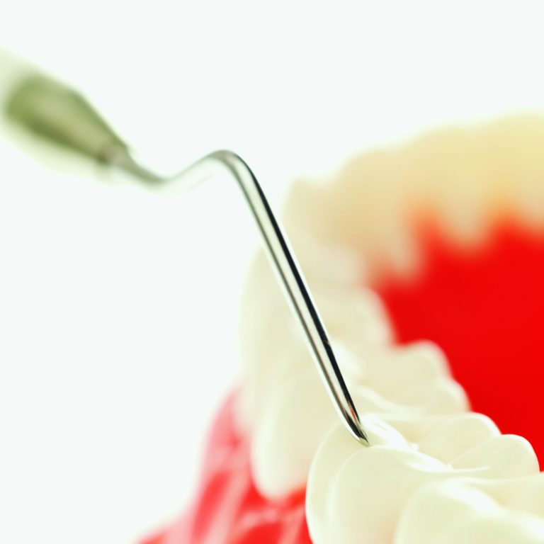 Protocolli di carico implantare nelle edentuli parziali