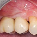 Rigenerazione ossea guidata con membrane non riassorbibili