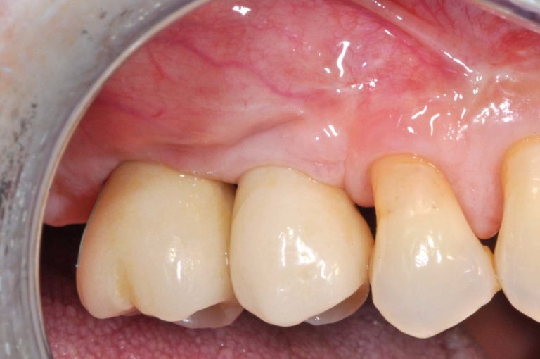 Rigenerazione ossea guidata con membrane non riassorbibili