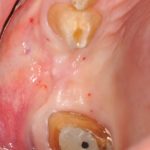 Approccio minimamente invasivo nel rialzo di seno mascellare per via crestale