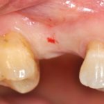 Attuali tendenze nel rialzo di seno mascellare per via transalveolare