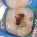 Il trattamento endodontico dei terzi molari