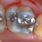 VPT e odontoiatria conservativa su denti permanenti