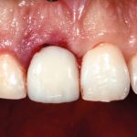 Studio preliminare sulla risposta dei tessuti molli e duri a un nuovo impianto transgengivale con collare convergente