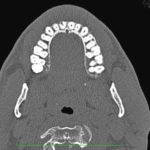 Indicazioni all’utilizzo della CBCT in parodontologia