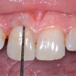 Valutazione dell’effetto desensibilizzante del laser Nd:YAG, di una vernice al fluoro e del loro uso combinato sulla dentina ipersensibile. Studio in vivo e in vitro