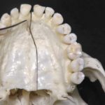 Analisi morfometrica del canale nasopalatino