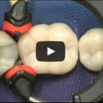 Quantificare lo stato di salute di un’otturazione