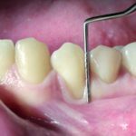 Fattori che condizionano la ricopertura radicolare singola