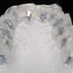 Metodica semplificata per il bandaggio indiretto con attacchi 2D