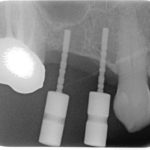 Tecnica atraumatica di rialzo di seno mascellare per via transcrestale