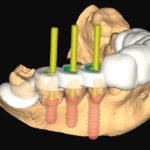 Nuovi orientamenti in implantoprotesi