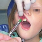 Tecniche e strumenti per l’anestesia locale in odontoiatria