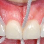 Il restauro estetico degli incisivi centrali con faccette adesive: quale scelta?