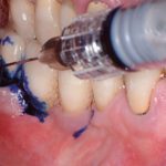 La terapia fotodinamica antimicrobica nel trattamento della perimplantite