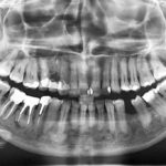 Displasia cemento-ossea nella variante florida. Case report