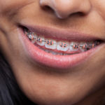 Metodica Alt-RAMEC nel trattamento precoce delle III classi trattamento precoce delle III classi