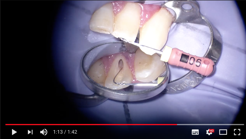 DM_il dentista moderno_obliterazione pulpare