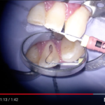 Obliterazione pulpare DM_il dentista moderno_obliterazione pulpare