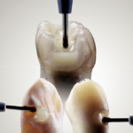 Compositi bulk-fill: SDR Flow+ caratteristiche ancora migliori ne aumentano le indicazioni