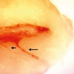 Lo spazio endodontico: detersione 3D
