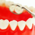 La terapia laser per ridurre la sensibilità dentinale Fotobiostimolazione Laser in odontoiatria