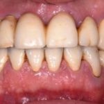 La perimplantite crescerà da qui al 2025