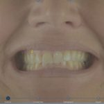 Il progetto digitale per il ripristino della dimensione verticale