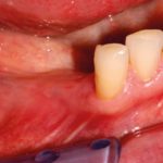 La chirurgia guidata nel trattamento delle edentulie parziali