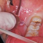 Anestesia locale computerizzata con il sistema Wand®STA®