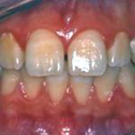 Aspetti occlusali nella patogenesi della cheilite angolare