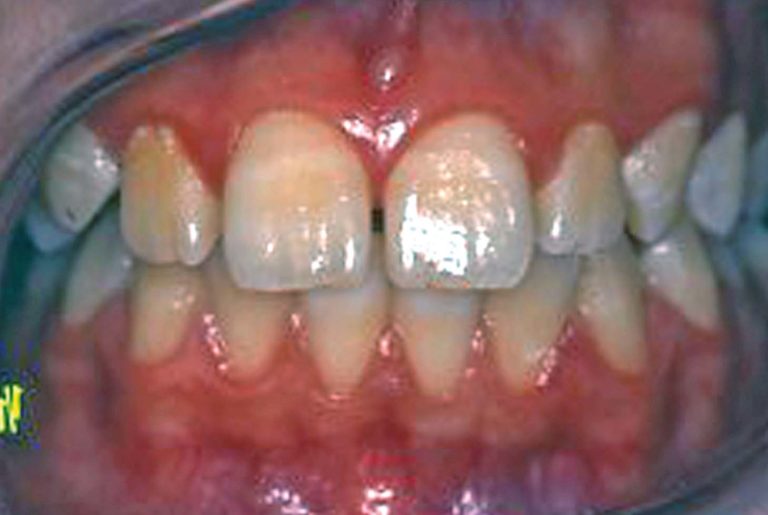 Aspetti occlusali nella patogenesi     della cheilite angolare