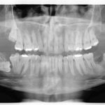 Autotrapianto di ottavo incluso a sostituzione di un settimo irrimediabilmente compromesso: case report