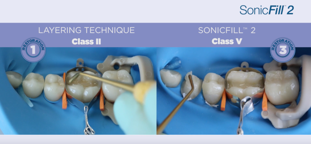 DM_Il dentista moderno_tecnica bulk fill