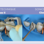 Tecnica bulk-fill semplificata nei settori posteriori DM_Il dentista moderno_tecnica bulk fill
