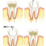 Mantenere la pervietà degli orifizi canalari durante build-up DM_il dentista moderno_ pervietà degli orifizi durante il build-up pre-endodontico