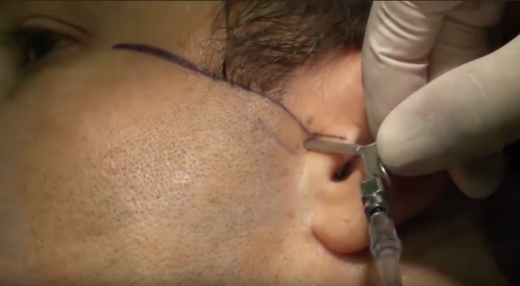 DM_il dentista moderno_artrocentesi_ATM