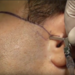 Aggiornamenti scientifici sull’artrocentesi dell’ATM DM_il dentista moderno_artrocentesi_ATM