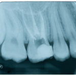 Errori in endodonzia: diagnostica peri e postoperatoria DM_il dentista moderno_errori in endodonzia_devitalizzazione