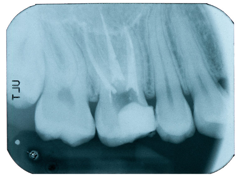 Errori in endodonzia: diagnostica peri e postoperatoria