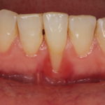 L’uso del PRF nel trattamento di recessioni multiple DM_il dentista moderno_recessioni gengivali