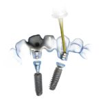 Approccio inedito all’implantologia