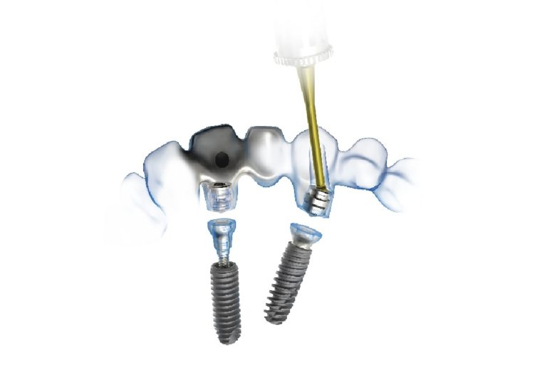 Compatibilità totale tra le filosofie Bone Level e Tissue Level