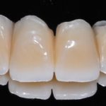 Tecnologie implantari a confronto: vantaggi e svantaggi di soluzioni tradizionali in titanio e alternative ceramiche