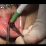 Placche ortodontiche di ancoraggio: infezione e fattori predittivi DM_il dentista moderno_Placche ortodontiche di ancoraggio infezione e fattori predittivi