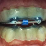 Il trattamento odontoiatrico in un paziente affetto da Osas