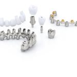 Soluzioni protesiche personalizzate e digitali con tecnologia CAD-CAM