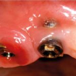 Efficacia dell’implantoplastica nel trattamento chirurgico della perimplantite: case series