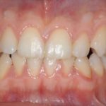 L’ortodonzia minimamente invasiva con ancoraggio strategico nel trattamento delle fratture radicolari